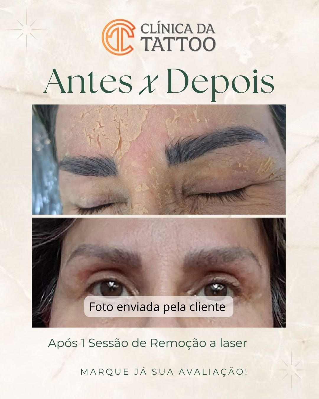 Instagram Post Antes e Depois Procedimento Estético Minimalista e Elegante (1080 x 1350 px)